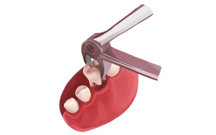 Illustration of a special dental tool extracting a baby tooth
